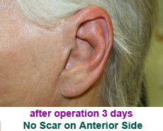 plastic-surgery-prominent-ear 